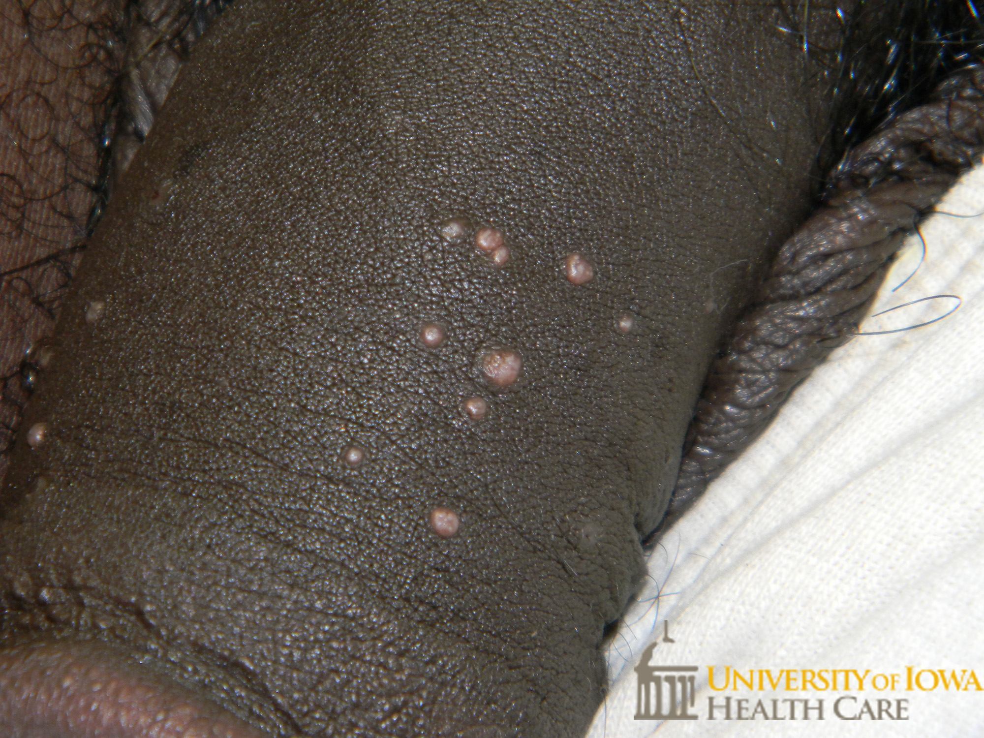 Pink papules with central umbilication on the penile shaft. (click images for higher resolution).